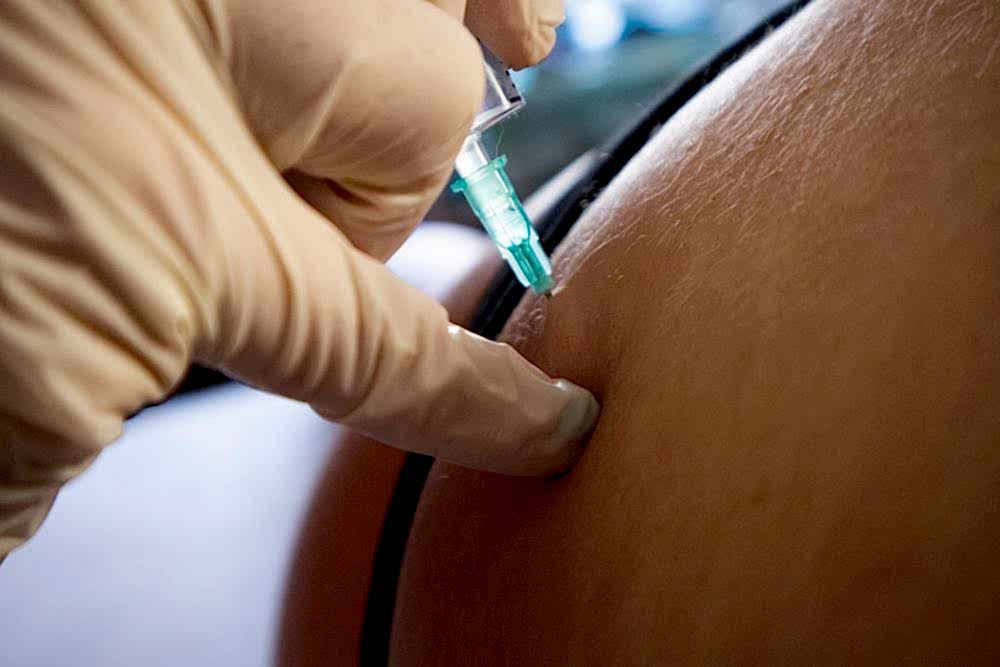 İNTRALEZYONEL KORTİKOSTEROİD ENJEKSİYONU