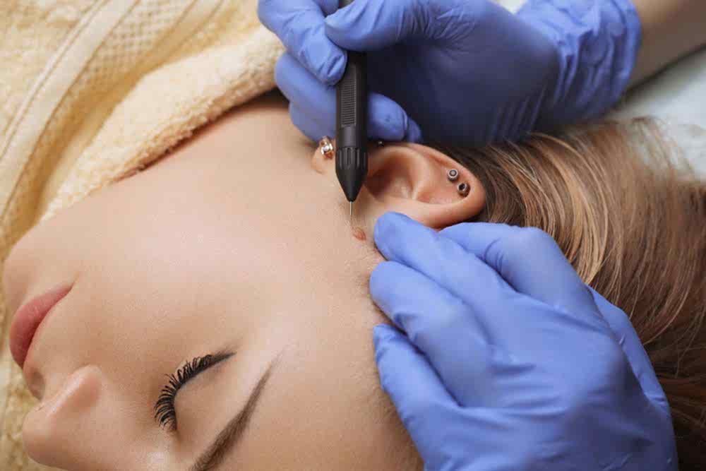 ELEKTRO KOTERİZASYON