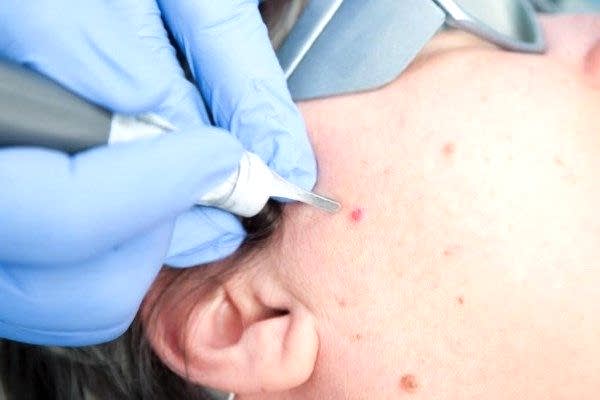 LAZER İLE BEN VE SİĞİL YAKMA