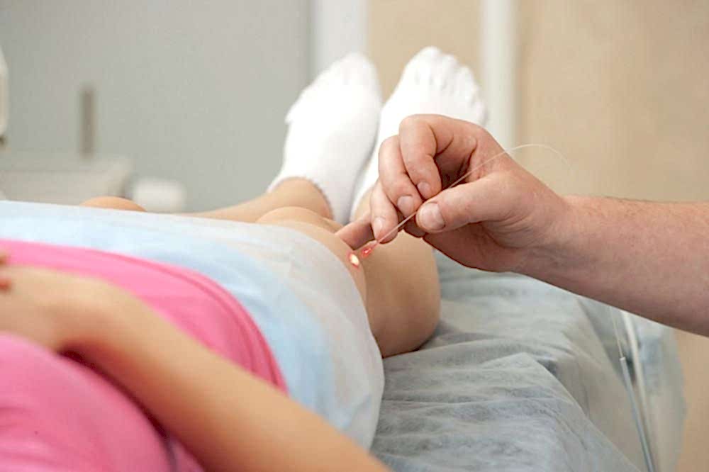 LAZER İLE KILCAL DAMAR TEDAVİSİ