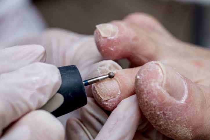 DİYABETİK AYAK VE YARA BAKIMI