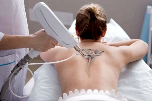 LAZER İLE DÖVME SİLME